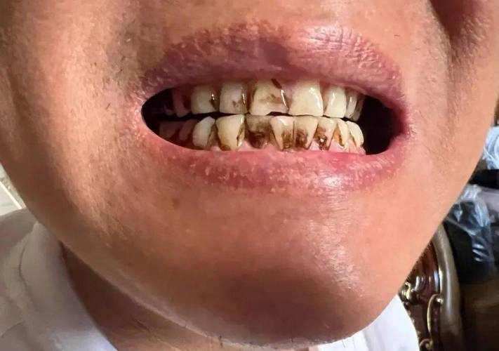 饮食 导致 牙齿 黑