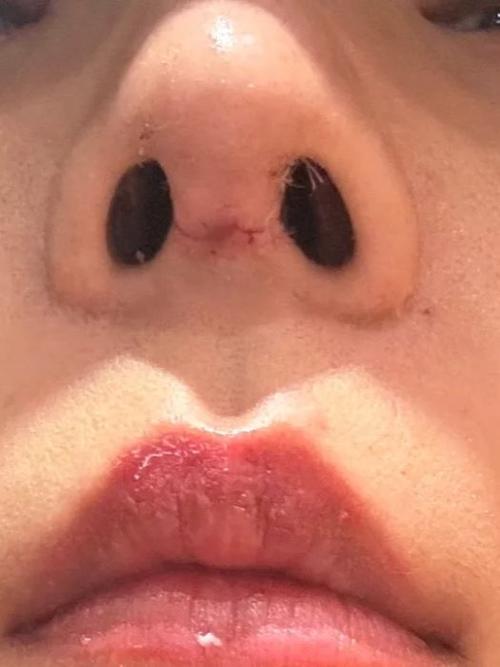 隆鼻 饮食 疤痕增生