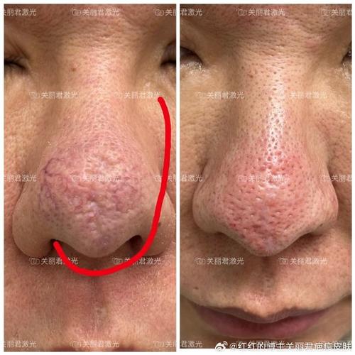 隆鼻 饮食 疤痕增生