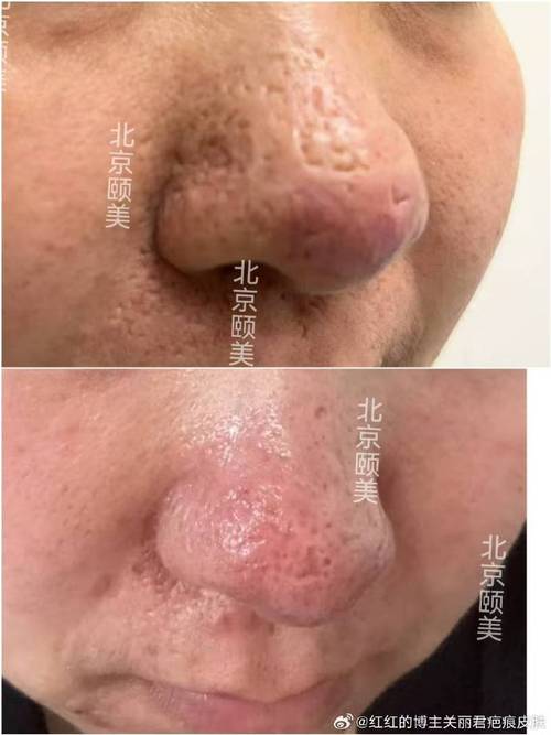 隆鼻 饮食 疤痕增生