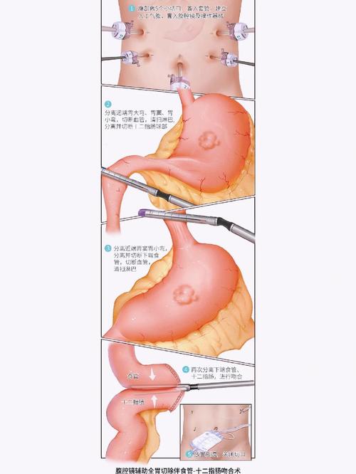 胃大部切除术饮食指导