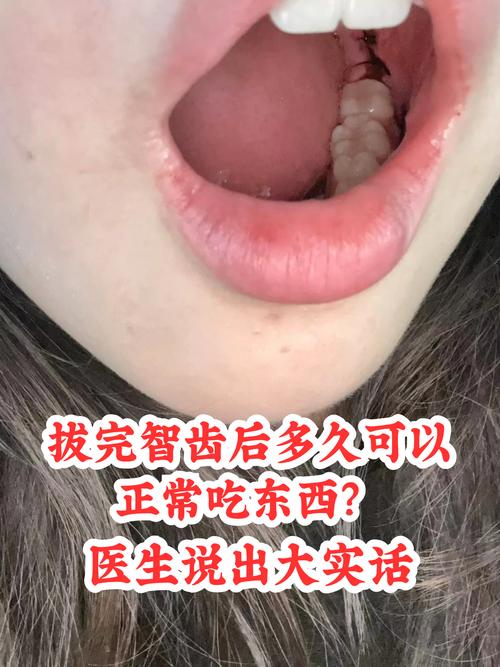 拔智齿多久能正常饮食