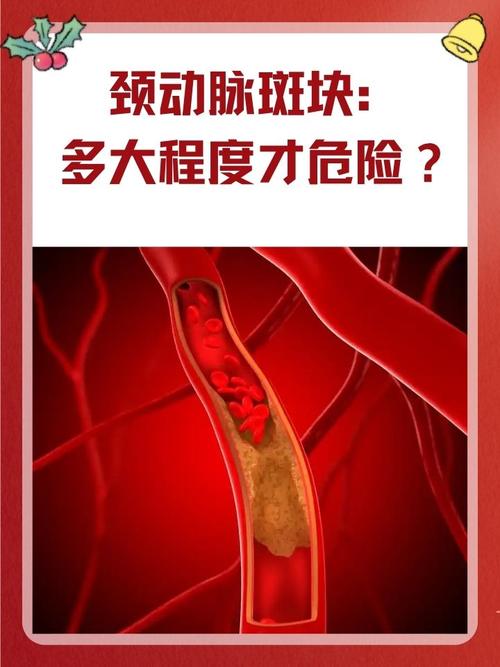 中医治疗动脉硬化斑块