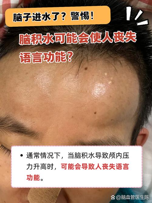 脑积水中医可以治疗吗