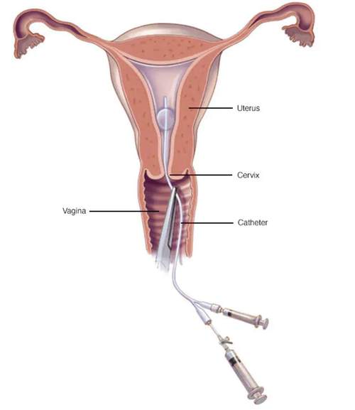 中医自检测输卵管图片