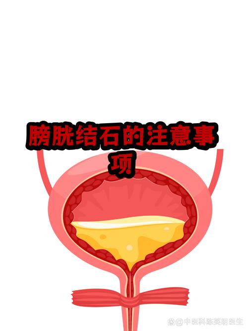 膀胱结石术后饮食禁忌