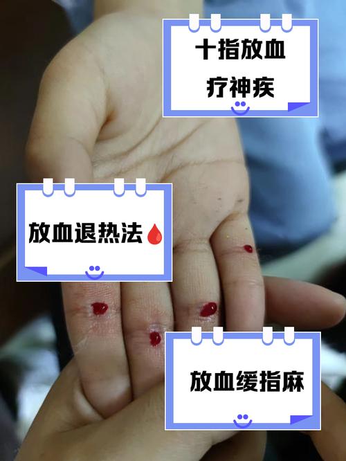 中医刺络放血疗法视频