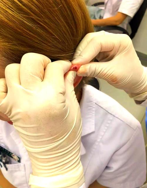 中医刺络放血疗法视频