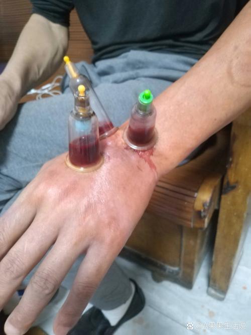 中医刺络放血疗法视频