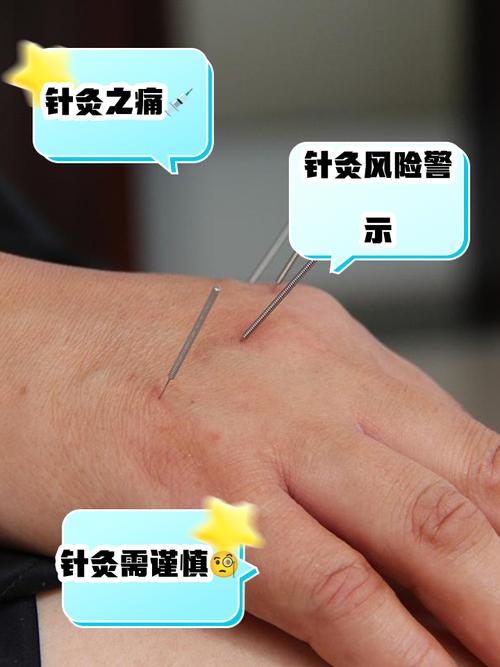 血栓流口水针炙穴位