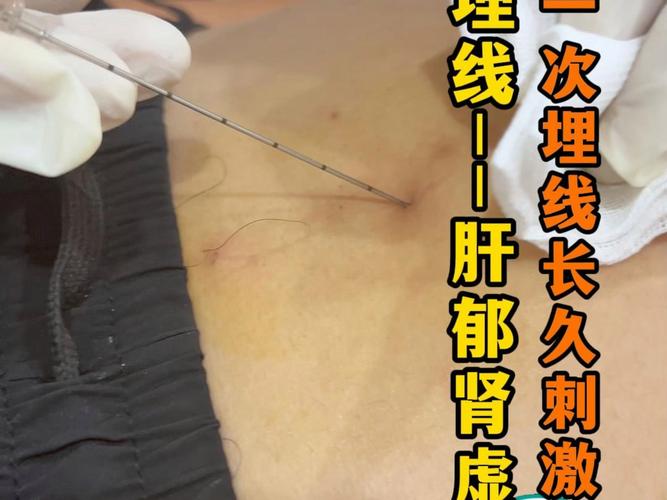 央视报道中医埋线危害