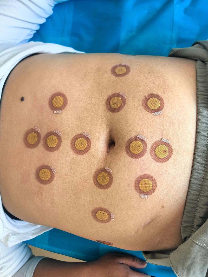 央视报道中医埋线危害