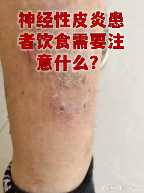 神经性皮炎病人的饮食