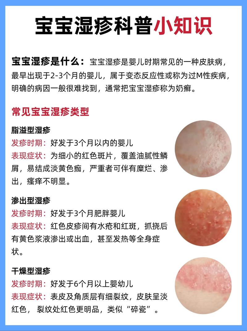 儿童湿疹中医怎么治疗