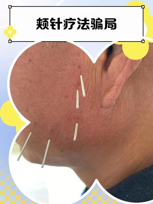 面瘫可以注射穴位针