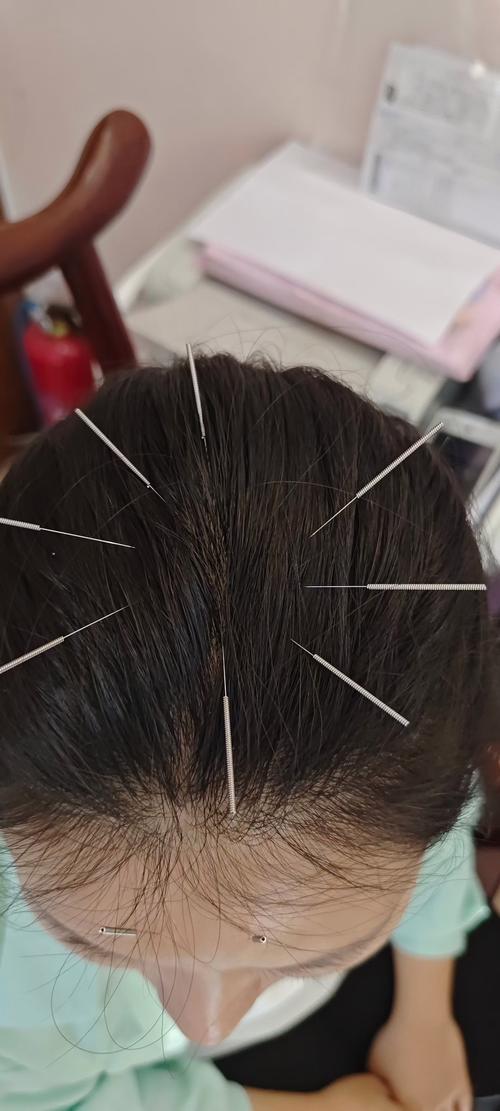 针灸治疗脑血管穴位