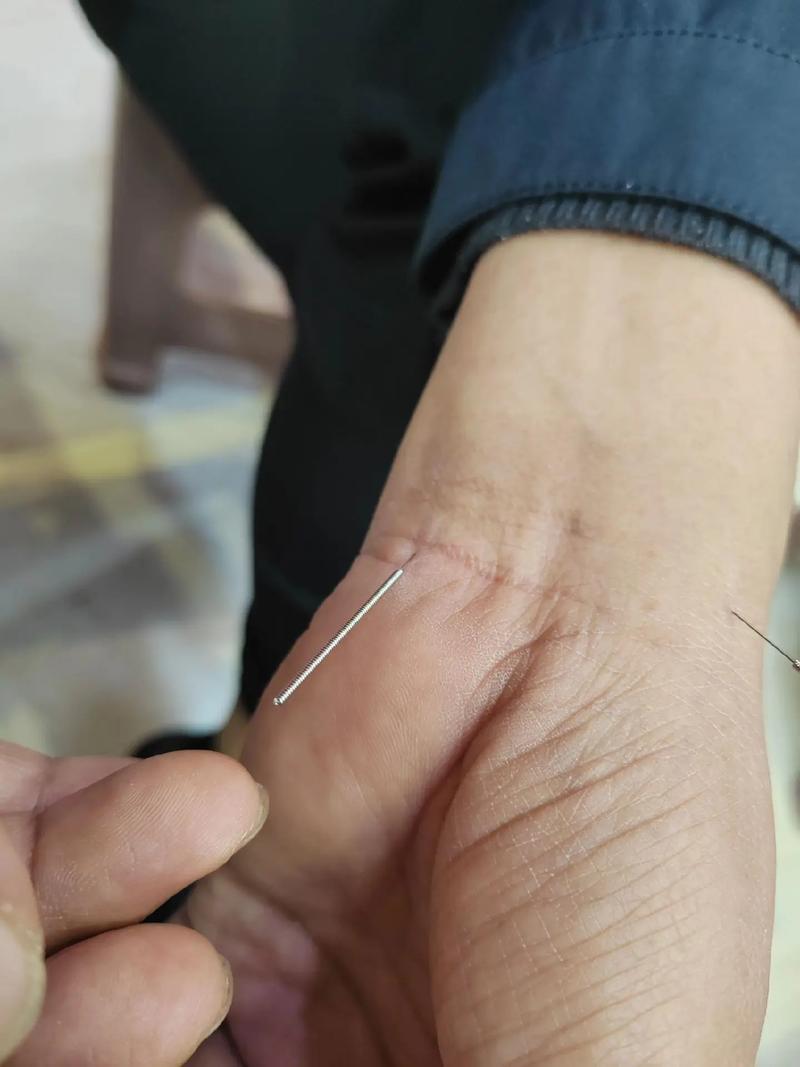 针灸治疗脑血管穴位